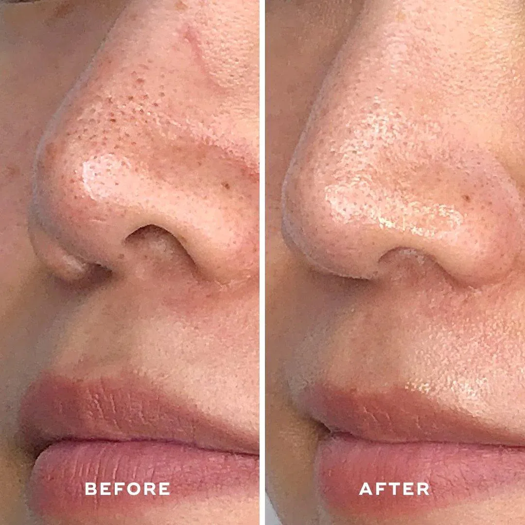 Aceology Detoxifying Treatment Mask