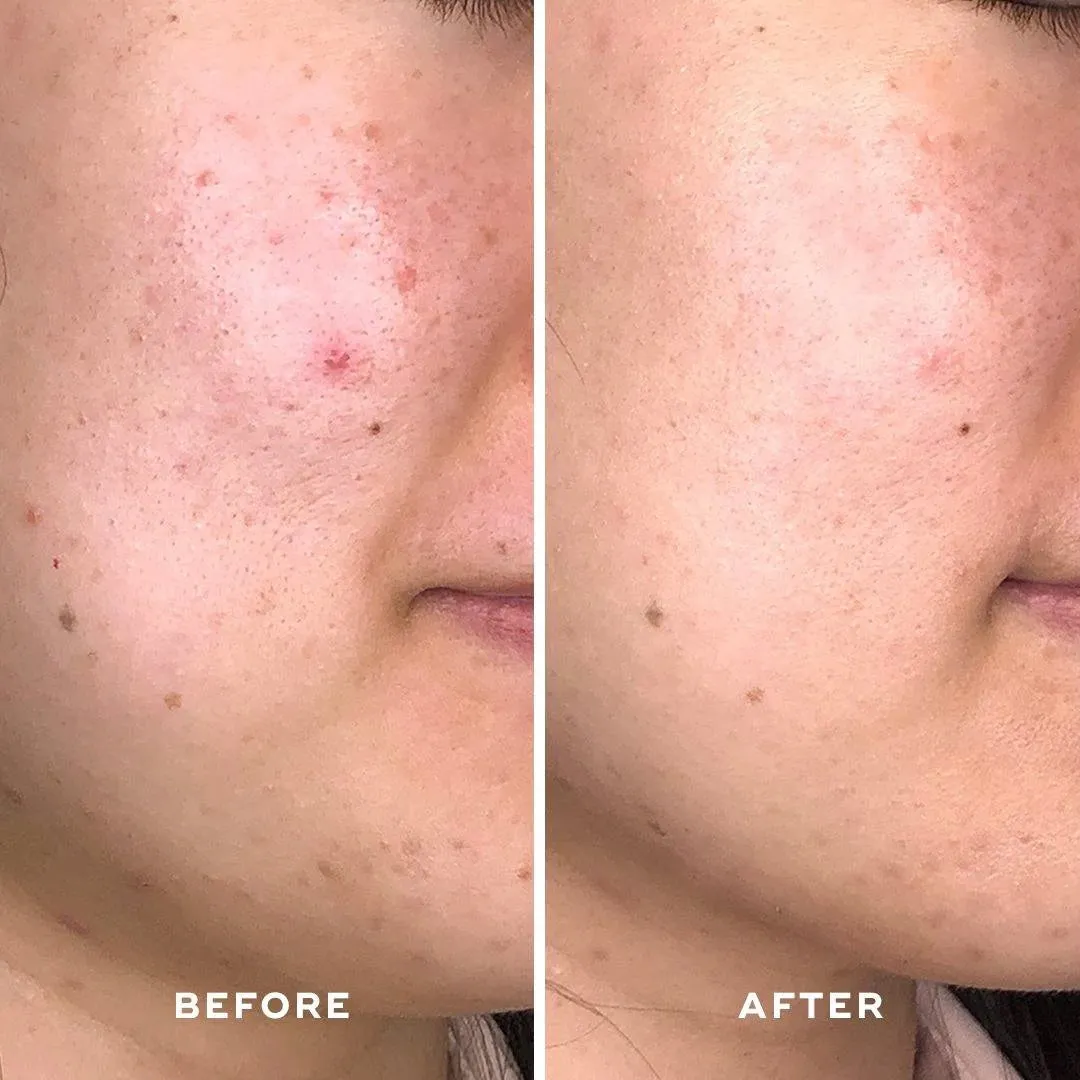 Aceology Detoxifying Treatment Mask